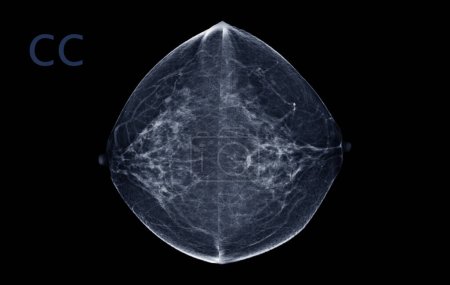 Téléchargez les photos : Mammographie numérique par rayons X de la vue CC des deux côtés. mammographie ou scanner du sein pour le cancer du sein montrant BI-RADS CATÉGORIE 2 Tumeur bénigne. - en image libre de droit
