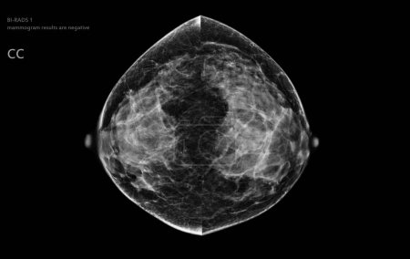 Téléchargez les photos : Mammographie numérique par rayons X des deux côtés de la vue CC. mammographie ou scanner du sein pour le cancer du sein Les résultats de la mammographie BI-RADS 1 sont négatifs. - en image libre de droit