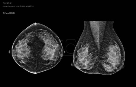 Téléchargez les photos : Mammographie numérique par rayons X de la vue CC latérale et de la vue MLO. mammographie ou scanner du sein pour le cancer du sein Les résultats de la mammographie BI-RADS 1 sont négatifs. - en image libre de droit