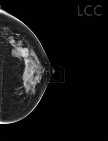 Téléchargez les photos : Mammographie numérique à rayons X Vue CC côté gauche. mammographie ou scanner du sein pour le cancer du sein BI-RADS 5 ; Très suggestif de tumeur maligne . - en image libre de droit