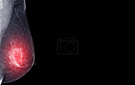 Téléchargez les photos : Mammographie numérique à rayons X de la vue MLO côté droit. mammographie ou scanner du sein pour le cancer du sein montrant BI-RADS CATÉGORIE 2 Tumeur bénigne. - en image libre de droit