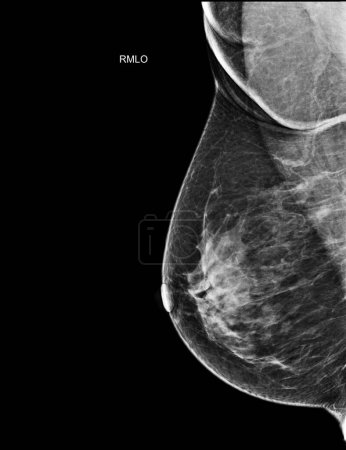 Photo for X-ray Digital Mammogram Right side MLO view . mammography or breast scan for Breast cancer BI-RADS 5; Highly suggestive of malignancy . - Royalty Free Image