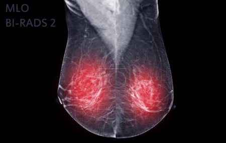 Téléchargez les photos : Mammographie numérique à rayons X de la vue MLO côté droit. mammographie ou scanner du sein pour le cancer du sein montrant BI-RADS CATÉGORIE 2 Tumeur bénigne. - en image libre de droit