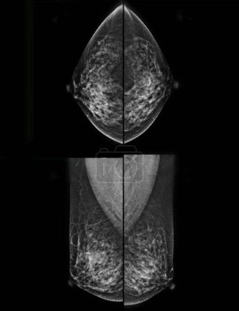 Téléchargez les photos : Mammographie numérique à rayons X de la vue CC et MLO. mammographie ou scanner mammaire pour le cancer du sein.. - en image libre de droit