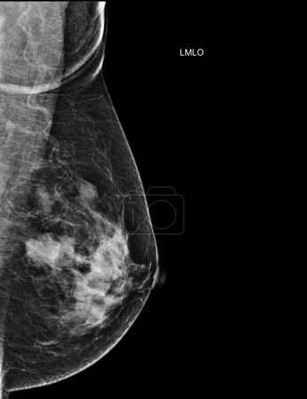 Röntgen-Digitales Mammogramm Links MLO-Ansicht. Mammographie oder Brustuntersuchung bei Brustkrebs BI-RADS 5; stark bösartig .