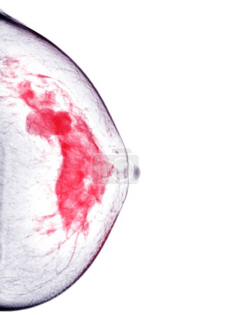 Téléchargez les photos : Mammographie numérique à rayons X Vue CC côté gauche. mammographie ou scanner du sein pour le cancer du sein BI-RADS 5 ; Très suggestif de tumeur maligne . - en image libre de droit
