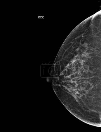 Téléchargez les photos : Mammographie Numérique à Rayons X Vue CC côté droit. mammographie ou scanner du sein pour le cancer du sein montrant BI-RADS CATÉGORIE 2 Tumeur bénigne. - en image libre de droit