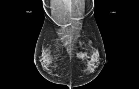 Téléchargez les photos : Mammographie numérique à rayons X vue MLO des deux côtés. mammographie ou scanner du sein pour le cancer du sein BI-RADS 5 ; Très suggestif de tumeur maligne . - en image libre de droit