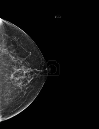 Photo for X-ray Digital Mammogram Left side  CC view . mammography or breast scan for Breast cancer  showing BI-RADS CATEGORY 2  Benign tumor. - Royalty Free Image