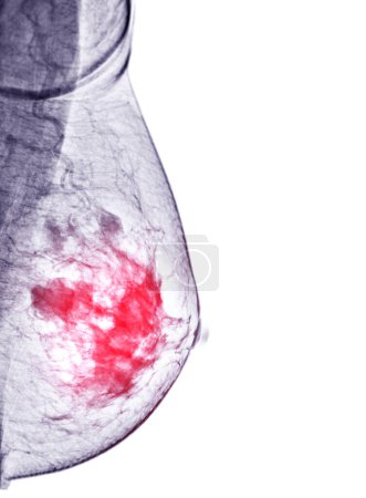 Téléchargez les photos : Mammographie numérique à rayons X Vue MLO côté droit. mammographie ou scanner du sein pour le cancer du sein BI-RADS 5 ; Très suggestif de tumeur maligne . - en image libre de droit