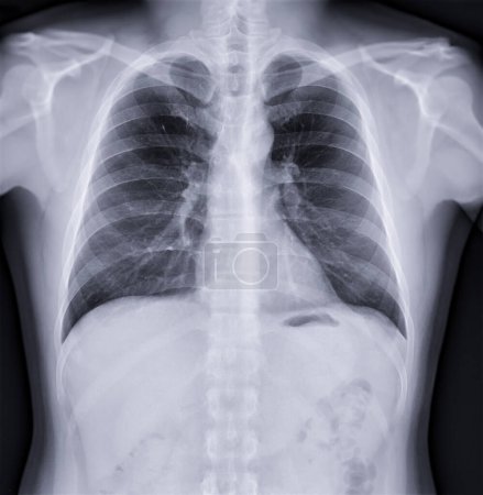 Photo for Chest x-ray image , Normal Chest. - Royalty Free Image