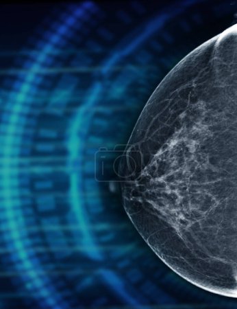 Téléchargez les photos : Mammographie Numérique à Rayons X Vue CC côté droit. mammographie ou scanner du sein pour le cancer du sein montrant BI-RADS CATÉGORIE 2 Tumeur bénigne. - en image libre de droit