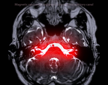 Photo for MRI Brain scan  with  the internal auditory canal (IAC) axial view. - Royalty Free Image