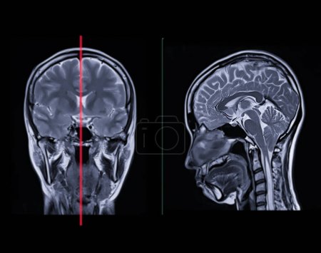 Photo for MRI  brain scan  Compare Coronal and sagittal plane for detect  Brain  diseases sush as stroke disease, Brain tumors and Infections. - Royalty Free Image