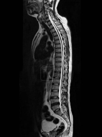 Téléchargez les photos : IRM du plan sagittal entier de la colonne vertébrale T2W pour la compression diagnostique de la moelle épinière. - en image libre de droit
