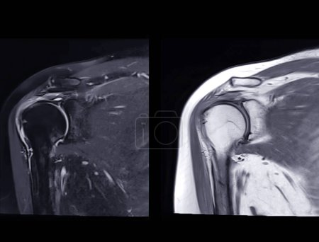 Imágenes por resonancia magnética o resonancia magnética de la articulación del hombro Coronal T2 FS y PDW para el diagnóstico del dolor en el hombro.