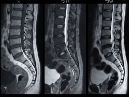 Photo for MRI L-S spine or lumbar spine Sagittall T1W ,T2 FS and T2W view  for diagnosis spinal cord compression. - Royalty Free Image