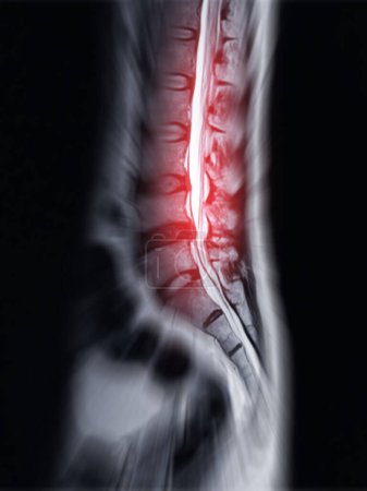 Foto de RM L-S columna vertebral o columna lumbar Sagittall T2W ver para el diagnóstico compresión de la médula espinal. - Imagen libre de derechos