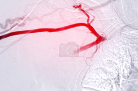 Photo for Image of Angioplasty, balloon angioplasty and percutaneous transluminal angioplasty (PTA) . - Royalty Free Image