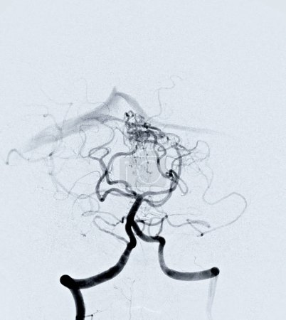 Photo for Cerebral angiography  image from Fluoroscopy in intervention radiology  showing cerebral artery. - Royalty Free Image