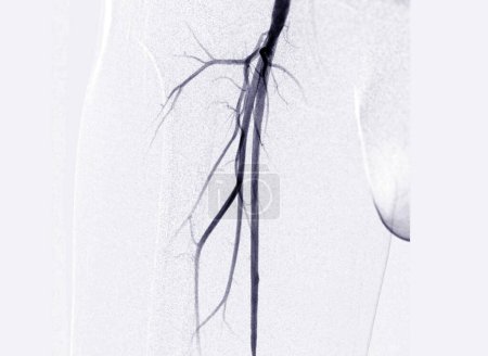 Photo for Femoral artery angiogram or angiography - Royalty Free Image