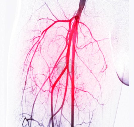 Angiographie de l'artère fémorale ou angiographie 