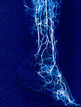 Photo for Foot angiorgam or Plantar angiogram angiogram showing  Plantar and Tarsal  Artery at foot area. - Royalty Free Image
