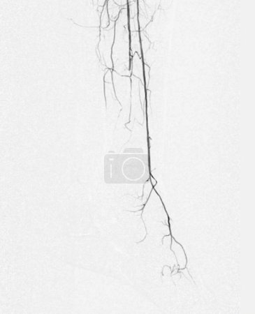 Téléchargez les photos : Angiorgame du pied ou angiographie plantaire angiographie montrant l'artère plantaire et tarsienne à la surface du pied. - en image libre de droit
