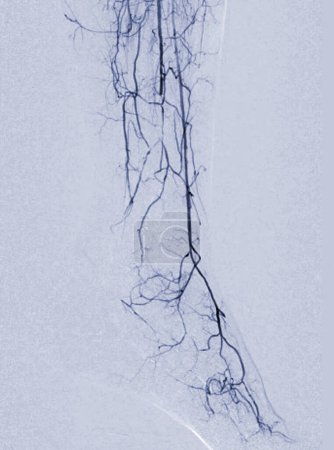 Téléchargez les photos : Angiorgame du pied ou angiographie plantaire angiographie montrant l'artère plantaire et tarsienne à la surface du pied. - en image libre de droit