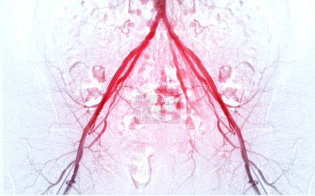 Foto de Angiografía o angiografía de la arteria femoral - Imagen libre de derechos