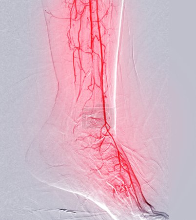 Foto de Angiorgam del pie o angiograma plantar que muestra arteria plantar y tarsal en la zona del pie. - Imagen libre de derechos