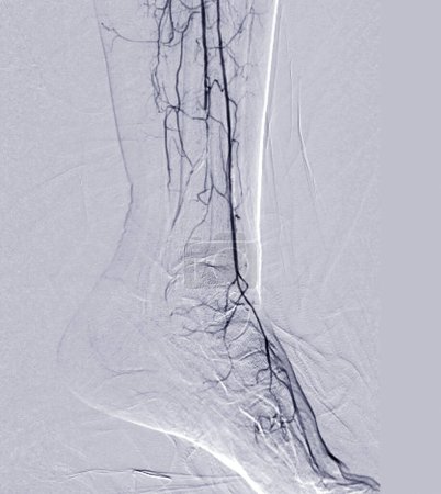 Foto de Angiorgam del pie o angiograma plantar que muestra arteria plantar y tarsal en la zona del pie. - Imagen libre de derechos