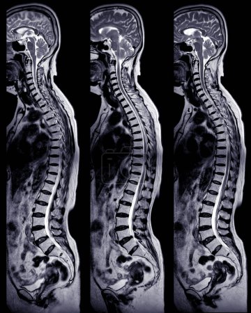 Téléchargez les photos : IRM dépistage de la colonne vertébrale complète pour le diagnostic compression de la moelle épinière
. - en image libre de droit