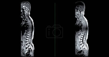 Photo for MRI whole spine screening for diagnosis spinal cord compression. - Royalty Free Image