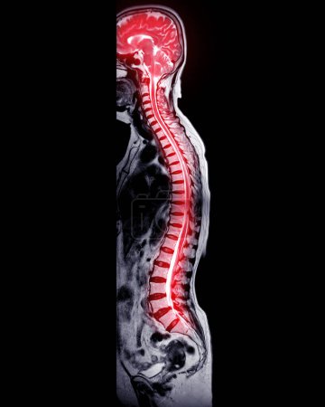 Foto de Resonancia magnética de columna entera para el diagnóstico compresión de la médula espinal
. - Imagen libre de derechos