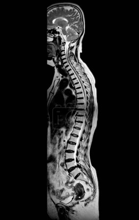 Photo for MRI whole spine screening for diagnosis spinal cord compression. - Royalty Free Image
