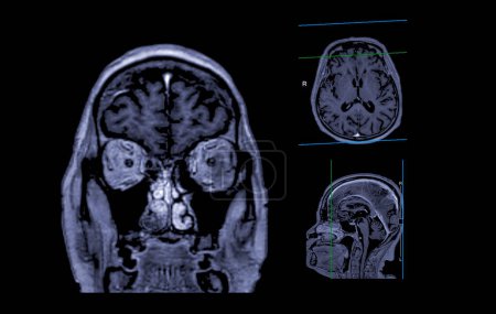 Photo for MRI  brain scan Axial , Coronal and sagittal view with referance line for detect  Brain  diseases sush as stroke disease, Brain tumors and Infections. - Royalty Free Image