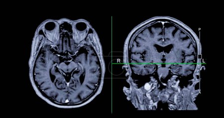 Photo for MRI  brain scan Axial and coronal view with reference line for detect  Brain  diseases sush as stroke disease, Brain tumors and Infections. - Royalty Free Image