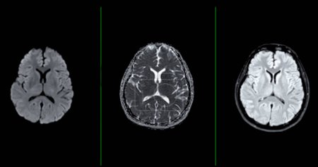Photo for MRI  brain scan  axial Diffusion technique  for detect  Brain  diseases sush as stroke disease, Brain tumors and Infections. - Royalty Free Image