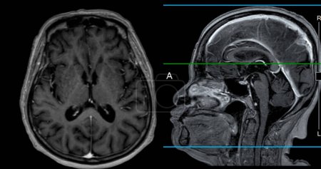 Photo for MRI  brain scan Axial  and sagittal view with reference line for detect  Brain  diseases sush as stroke disease, Brain tumors and Infections. - Royalty Free Image