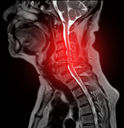 Téléchargez les photos : IRM de la colonne vertébrale C ou image par résonance magnétique de la colonne vertébrale cervicale sagittale T2 FS vue pour le diagnostic de la spondylose entraînant une myélopathie spondylotique cervicale et une fracture par compression. - en image libre de droit
