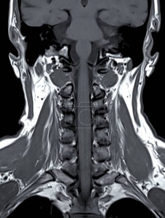 Téléchargez les photos : IRM de la colonne vertébrale C ou image par résonance magnétique de la colonne cervicale Vue coronale pour le diagnostic de la spondylose et de la fracture par compression. - en image libre de droit