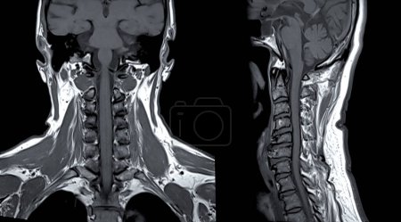 MRT der C-Wirbelsäule oder Magnetresonanzbild der Halswirbelsäule Koronale und sagittale Ansicht zur Diagnose Spondylose und Kompressionsfraktur.