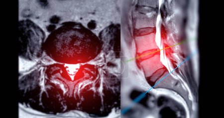 RM L-S columna vertebral o columna lumbar Técnica axial y sagital T2 con línea de referencia para el diagnóstico de compresión medular.