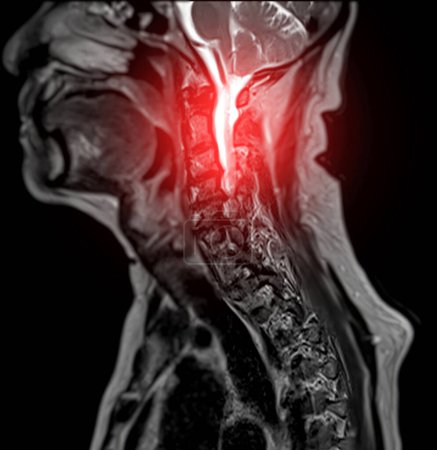 Téléchargez les photos : IRM de la colonne vertébrale C ou image par résonance magnétique de la colonne vertébrale cervicale sagittale T2 FS vue pour le diagnostic de la spondylose entraînant une myélopathie spondylotique cervicale et une fracture par compression. - en image libre de droit