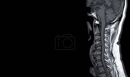 Téléchargez les photos : IRM de la colonne vertébrale C ou image par résonance magnétique de la colonne vertébrale cervicale vue sagittale pour le diagnostic de la spondylose et de la fracture par compression. - en image libre de droit