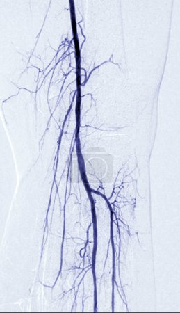 Foto de Angiografía de la arteria femoral o angiografía en el área de la rodilla. - Imagen libre de derechos