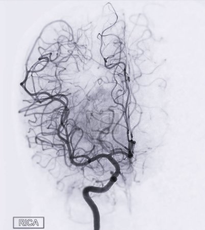 Téléchargez les photos : Cerebral angiography  image from Fluoroscopy in intervention radiology  showing cerebral artery. - en image libre de droit