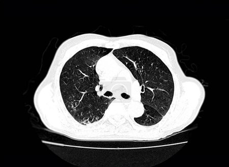 Photo for CT scan of Chest axial view for diagnostic Pulmonary embolism (PE) , lung cancer and covid-19. - Royalty Free Image