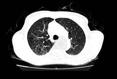 Foto de Tomografía computarizada de la vista axial del tórax para el diagnóstico Embolia pulmonar (EP), cáncer de pulmón y covid-19. - Imagen libre de derechos